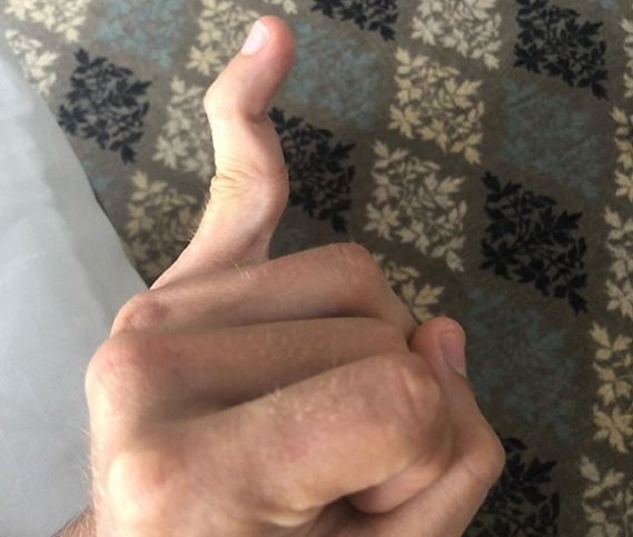 Дзюба продемонстрировал травмированный палец на руке: фото Дзюба продемонстрировал травмированный палец на руке: фото