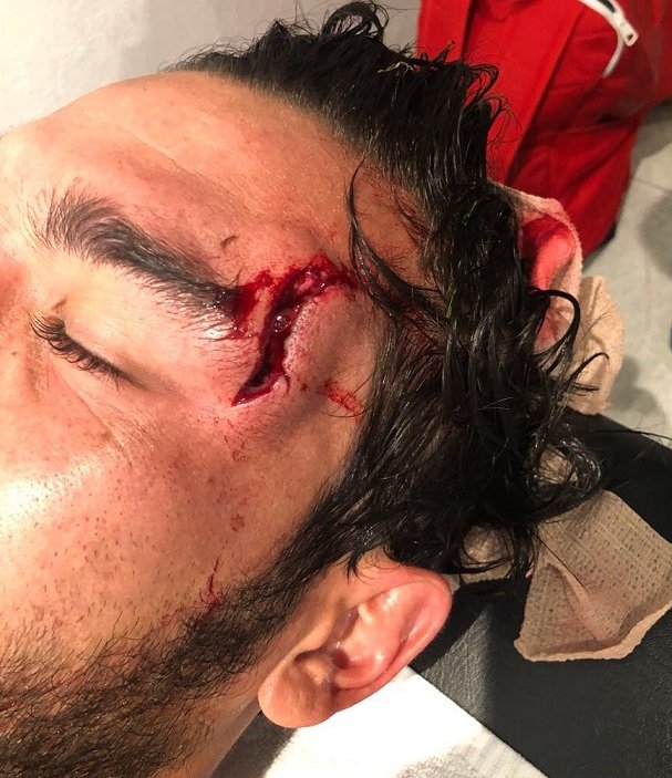 Игрок мексиканского Атласа получил рубленую травму головы: фото+видео Игрок мексиканского Атласа получил рубленую травму головы: фото+видео