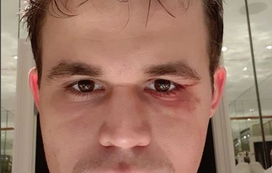 Магнусу Карлсену во время чемпионского матча по шахматам «подбили глаз» (Инстаграм) 