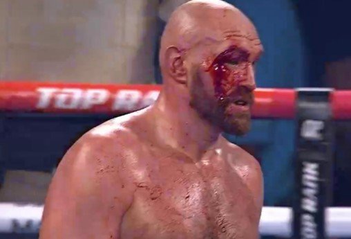 Тайсон Фьюри с серьезным рассечением смог победить Уаллина по очкам (Видео) Тайсон Фьюри с серьезным рассечением смог победить Уаллина по очкам (Видео)