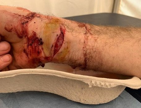 Французский мотогонщик проехал 40 км «Дакара» с самодельным жгутом